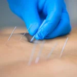 A physiotherapist performing dry needling physiotherapy on the back of the patient.