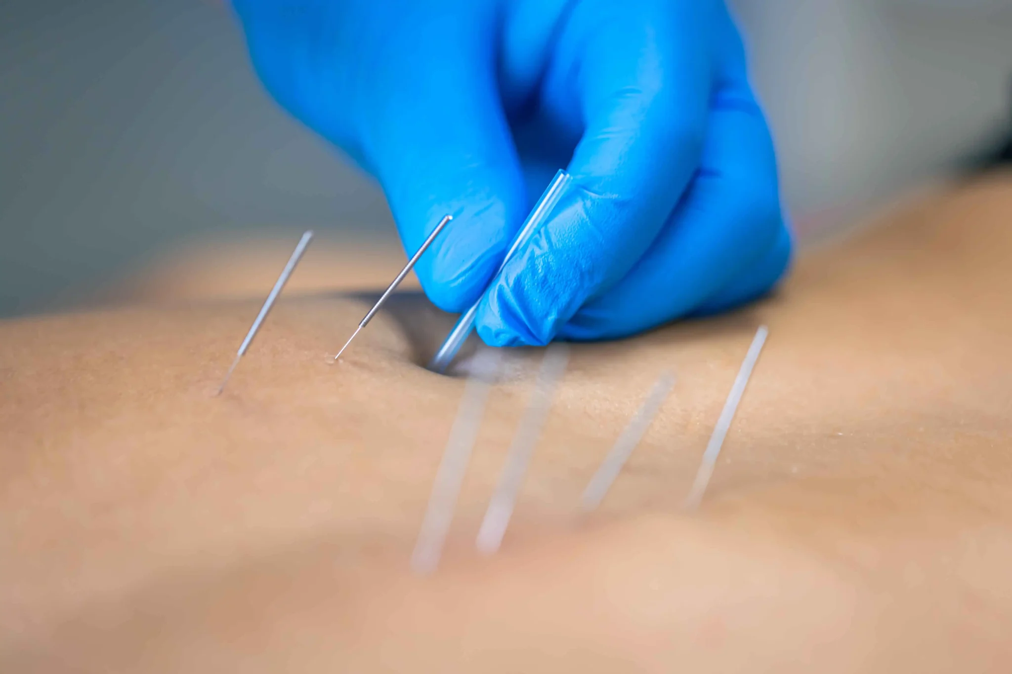 A physiotherapist performing dry needling physiotherapy on the back of the patient.